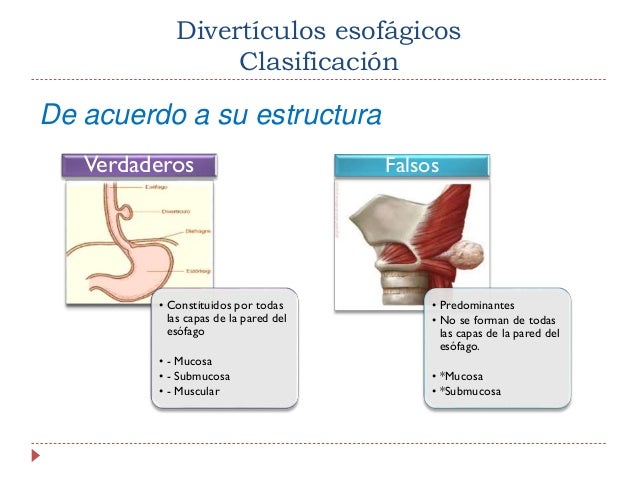 diverticulos esofagicos